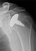 Arthrosurface shoulder