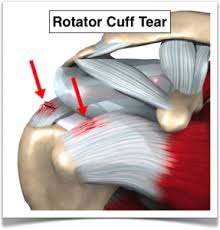 cuff tear 2