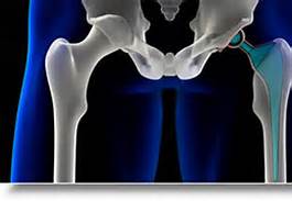 hip implant registry 2