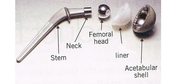 hip implant anatomy 2