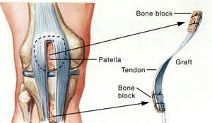 patellar tendon