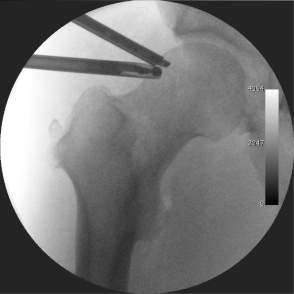 Arthroscopic-hip-x-ray 2