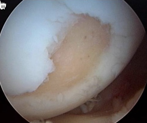 early knee cartilage loss