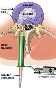 MIS discectomy