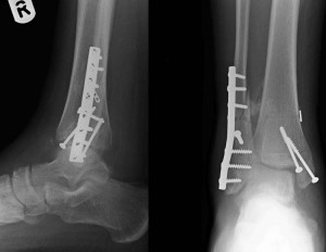 AAOS: 64% of military service members undergoing ankle fracture ...