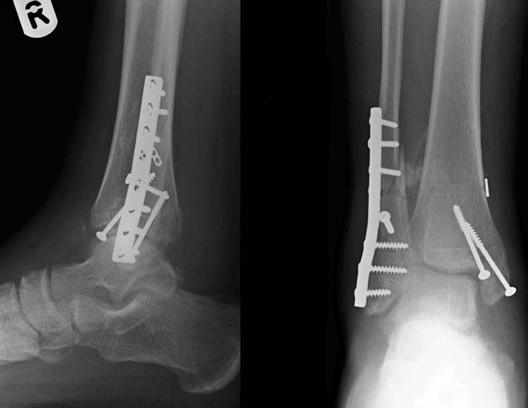 Ankle Fracture FX 2