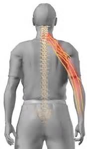 cervical radiculopathy 2