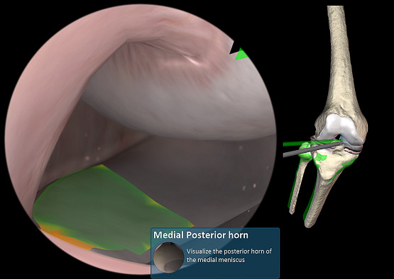 VirtaMed_ArthroS_Basic_Skills_Knee_VirtaMed_web555 2