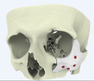 Xilloc_Medical_B_V____Patient_Specific_Implants