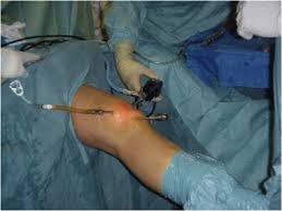 knee arthroscopy 2