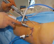 hip arthroscopy 2