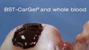 BST-CarGel®_Surgery_Video_-_YouTube