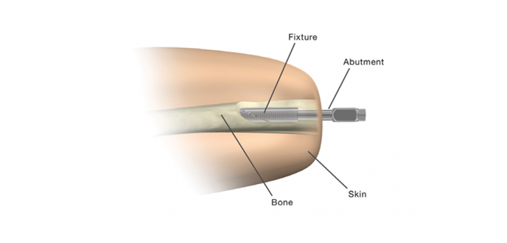 first_osteointegratedsurgery-2