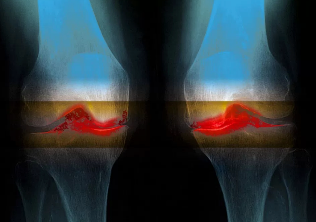 stem cell treatment for knee