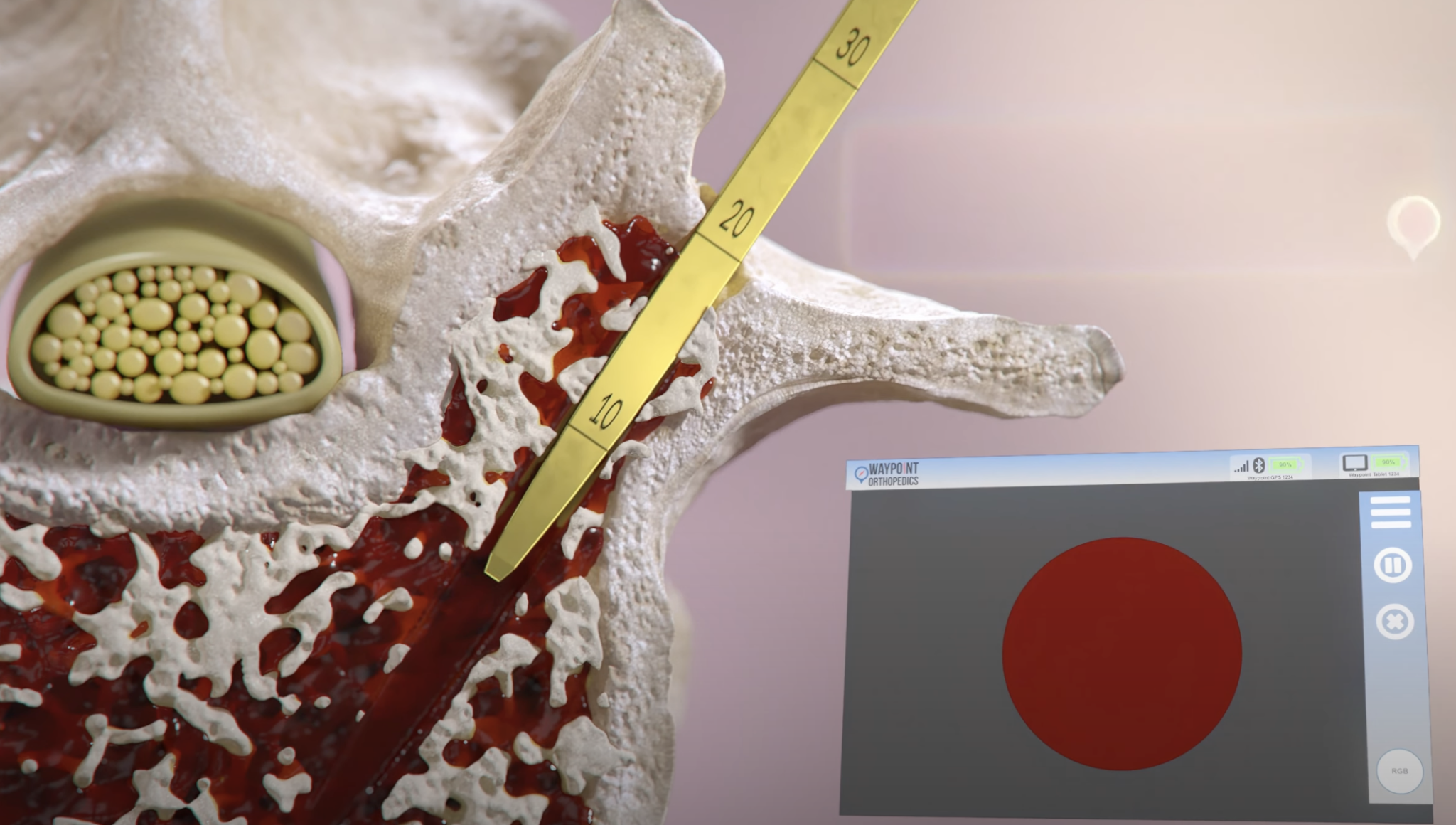 5 improved pedicle screw insertion technologies that do not require ...